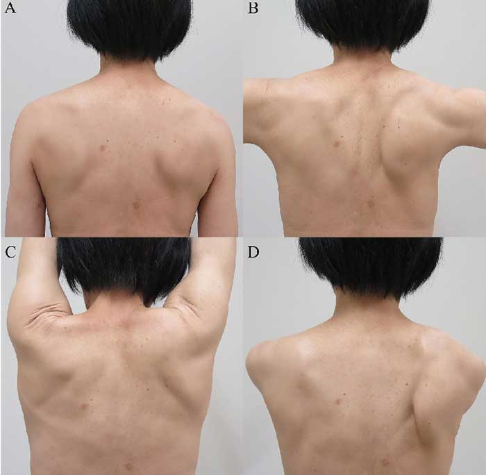 Scapular dysfunction and muscle imbalance