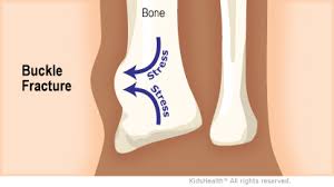 Diagram of Buckle Fracture.