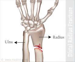 Diagram of Distal radius fractures.
