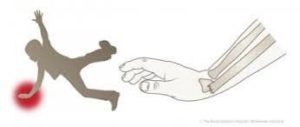Diagram of a kid falling on his hand.
