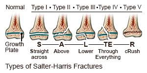 Types of Salter-Harris Fracture