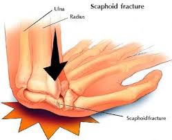 Diagram of scaphoid fractures.