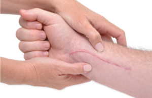 Scar on the hands